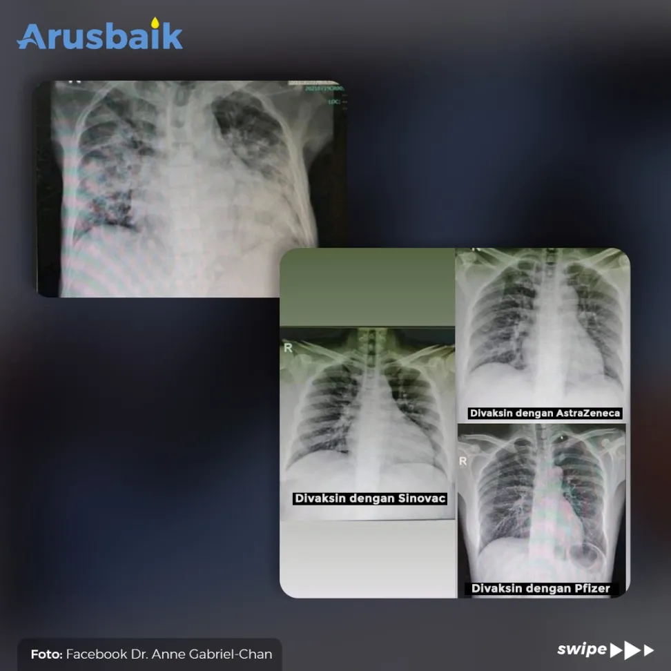 Vaksin Covid-19 Ampuh Cegah Pneumonia, Ini Buktinya